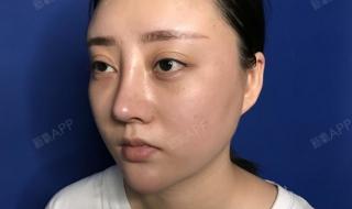 做鼻子要多少钱